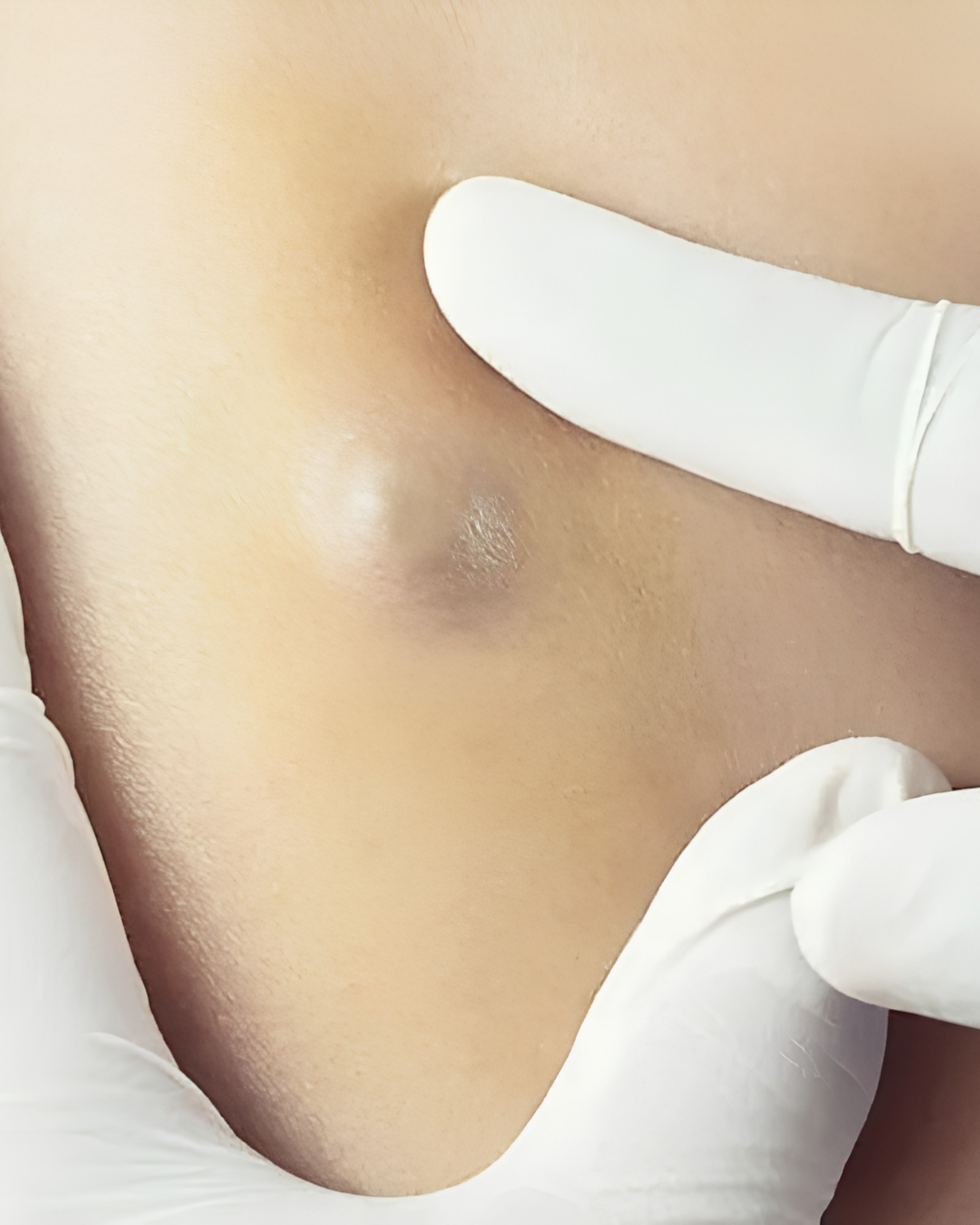 Advanced Dermoid Cyst Removal with Dermoid Cyst Excision at Cinch Clinics